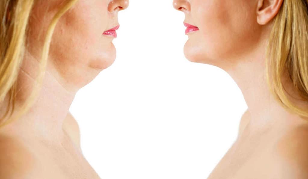 Double Chin treatment Streatham before and after results