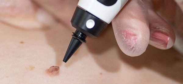 After Skin Tag Removal Streatham