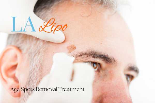What Are the Most Effective Treatments for Age Spots Streatham?