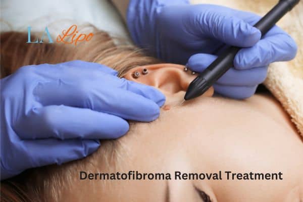 Dermatofibroma Removal Treatment Streatham