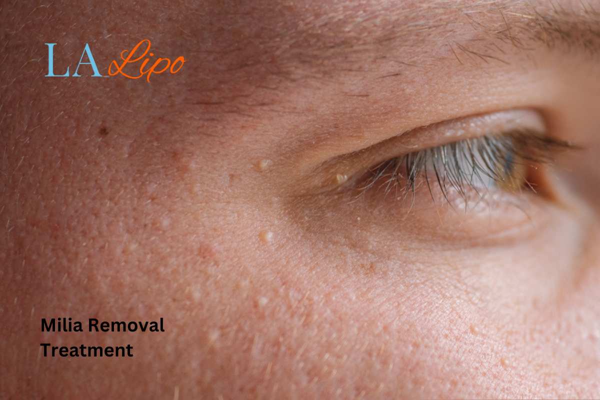 Cryopen Milia Removal: Is It the Easiest and Safest Option Streatham?