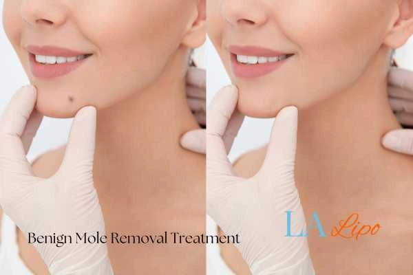 woman's before and after mole removal Streatham results