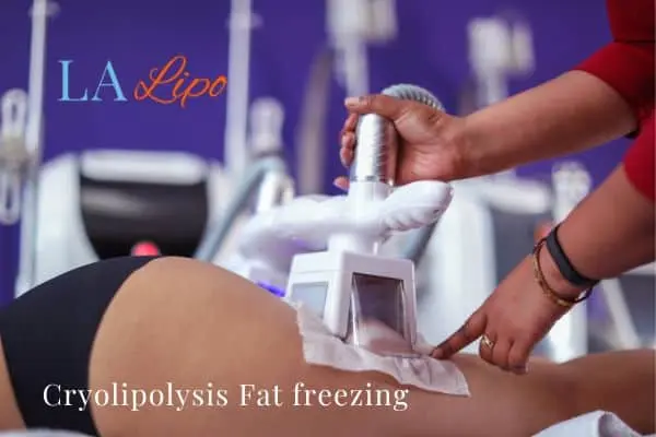 women getting fat freezing Streatham