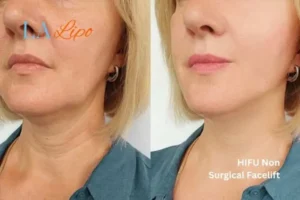 hi-fu for wrinkles Streatham before and after results