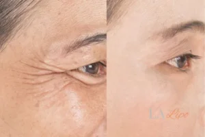Before and after results of woman - HI-fu wrinkles reduction treatment Streatham