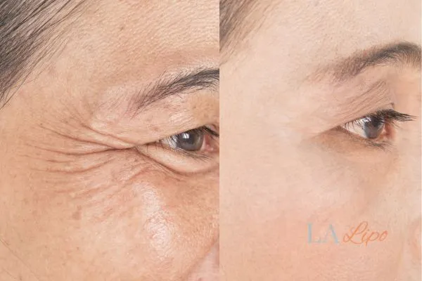 Before and after results of woman - HI-fu wrinkles reduction treatment Streatham
