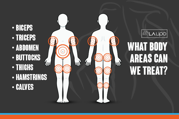 Graphic to show areas you can have LA-EMS Body Sculpting Streatham treatment.