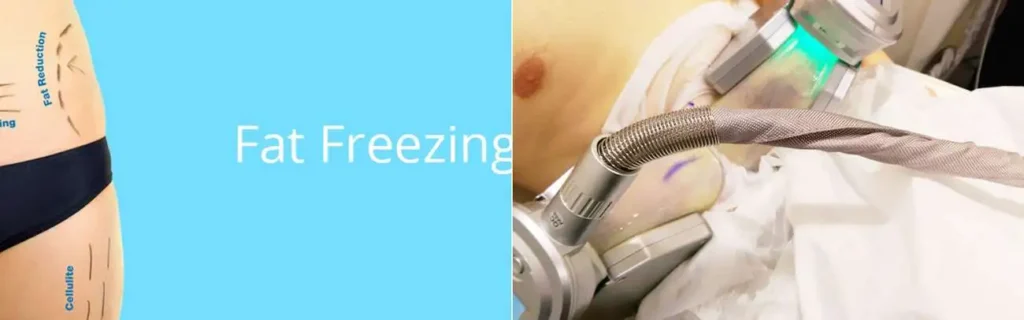 Fat freezing Streatham on multiple areas of the body