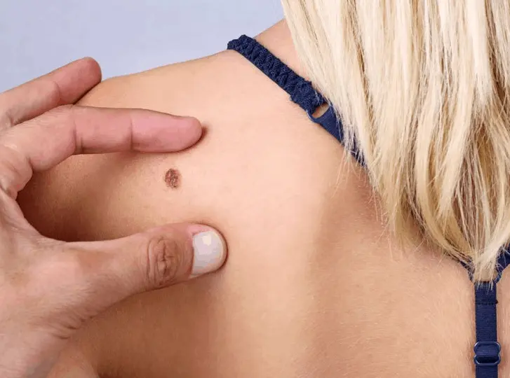 woman having mole removal Streatham consultation before treatment.
