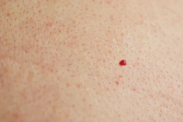 close up of a cherry angioma Streatham
