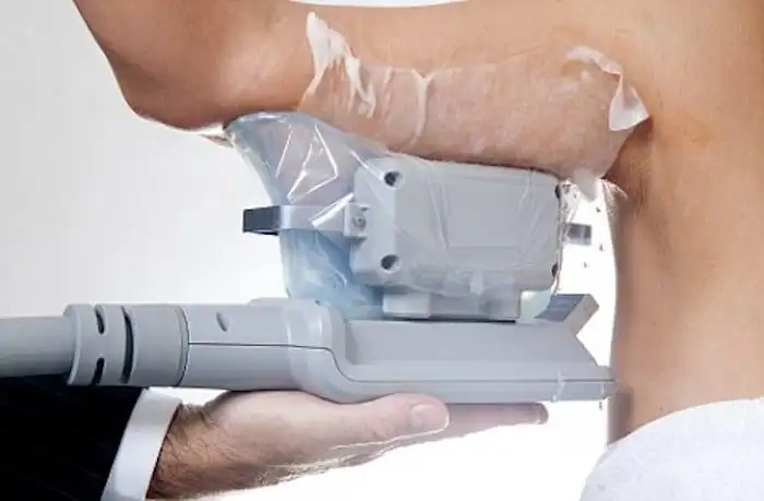 Picture of fat freezing Streatham on the upper arms.