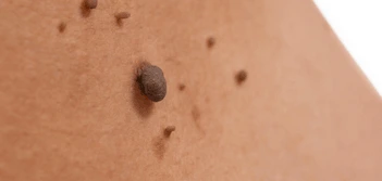 image of a skin tag Streatham