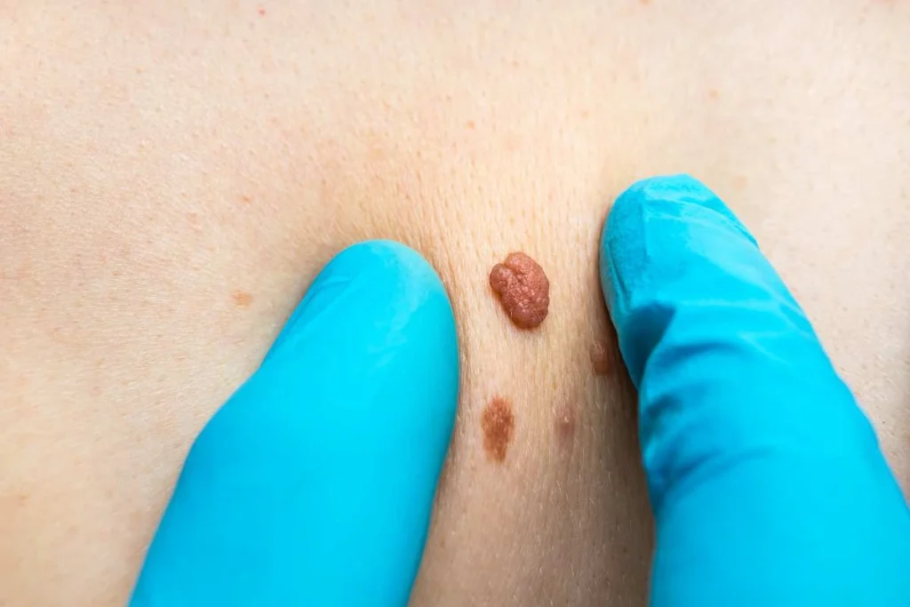 Consultant examining a skin tag Streatham