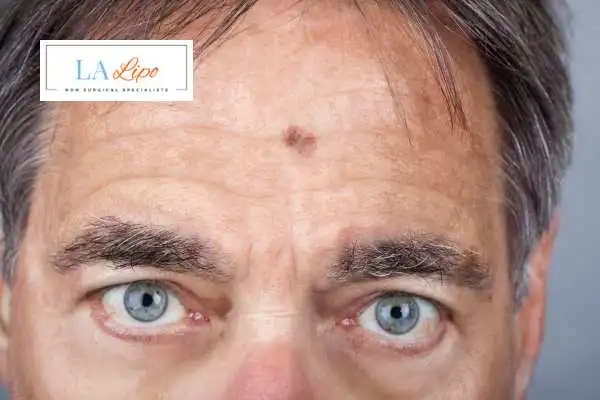 Solar Lentigo Removal Streatham image of man with mark on his forehead
