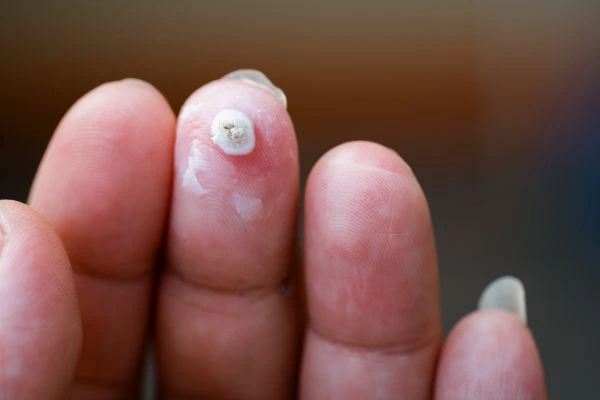 wart on person finger - cryotherapy to treat from LA LIPO Streatham