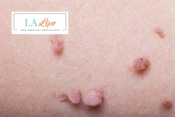 Does cryopen skin tag removal Streatham hurt? Find out now call our team today!