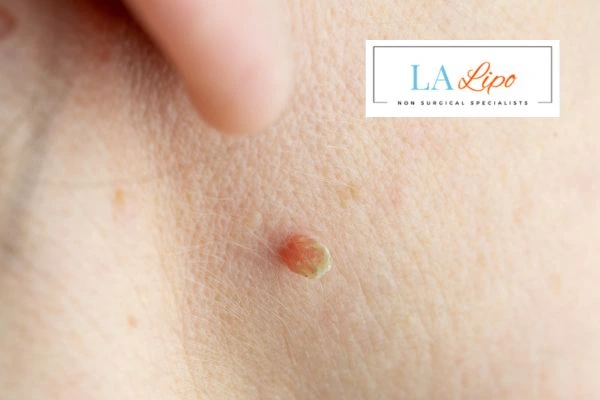 Book skin tag removal Streatham today speak to our team now!