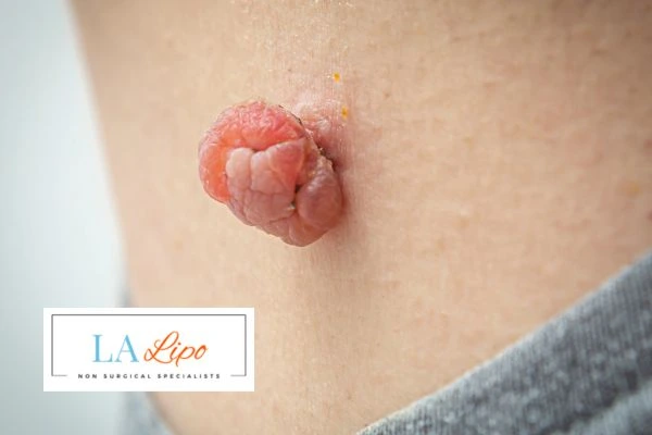 Interested in skin tag removal Streatham? Concerned about the pain? Find out more today!
