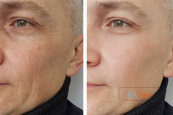 See the amazing results of Morpheus8 Treatment Streatham!