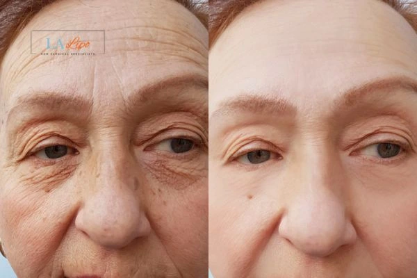 The powerful benefits of Morpheus8 Treatment Streatham - Call Our team today!