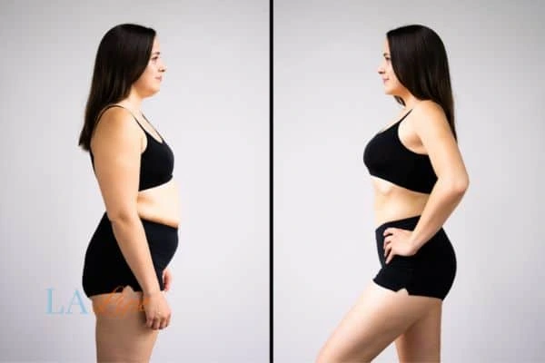 Picture of womans before and after using LA-EMS body sculpting to improve her core strength Streatham