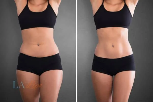 before and after results of non-surgical treatment to help a woman's body image and mental health Streatham
