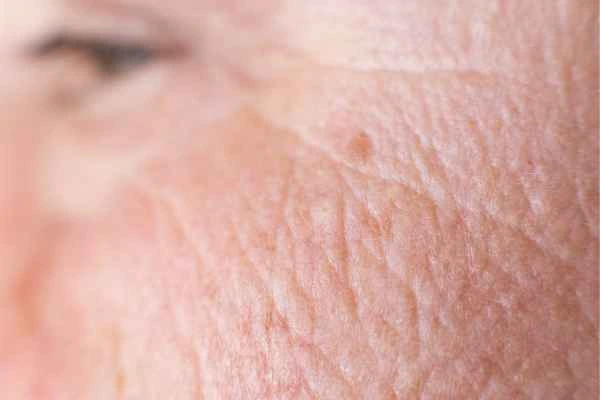close up picture of a woman's face showing an age spot Streatham