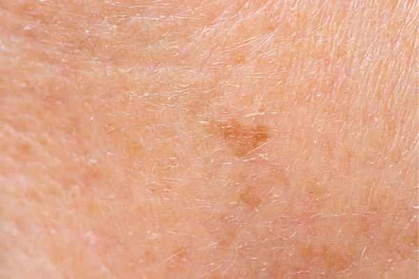 close up picture of age spots Streatham