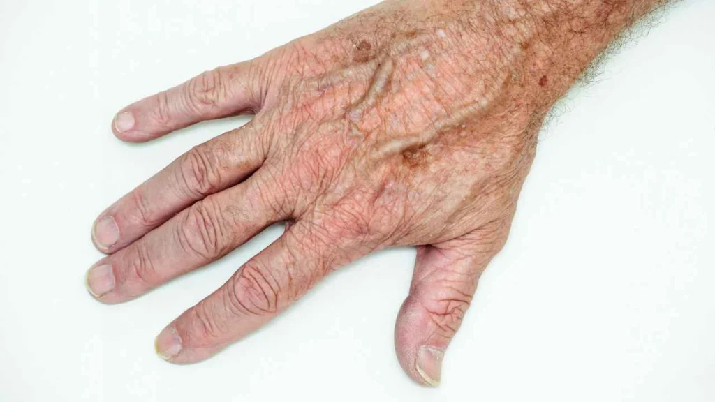 Male hand showing age spot Streatham