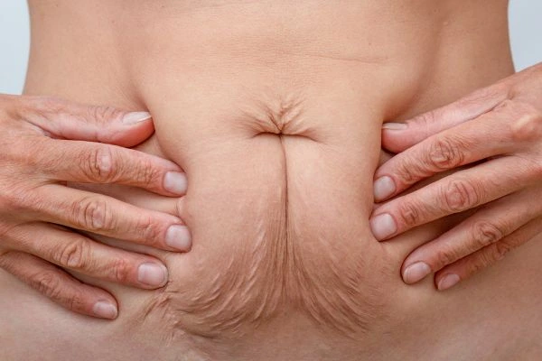 Image of a woman's stomach with loose skin - example of skin tightening Streatham options